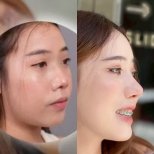 Before and after rhinoplasty result at Dr. Chen Surgery Hospital International Center, nose reshaping