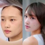 Before and after rhinoplasty result at Dr. Chen Surgery Hospital International Center, nose reshaping