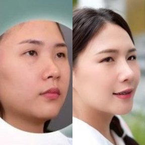 Before and after rhinoplasty result at Dr. Chen Surgery Hospital International Center, nose reshaping