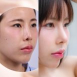 Before and after rhinoplasty results at Dr. Chen Surgery Hospital International Center, nose reshaping