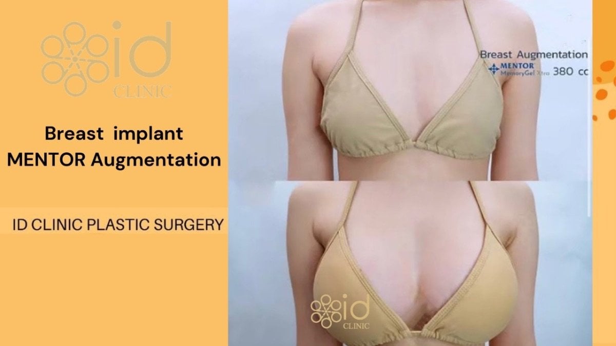 До и после увеличения груди имплантами Mentor в ID Clinic Bangkok, видимый результат