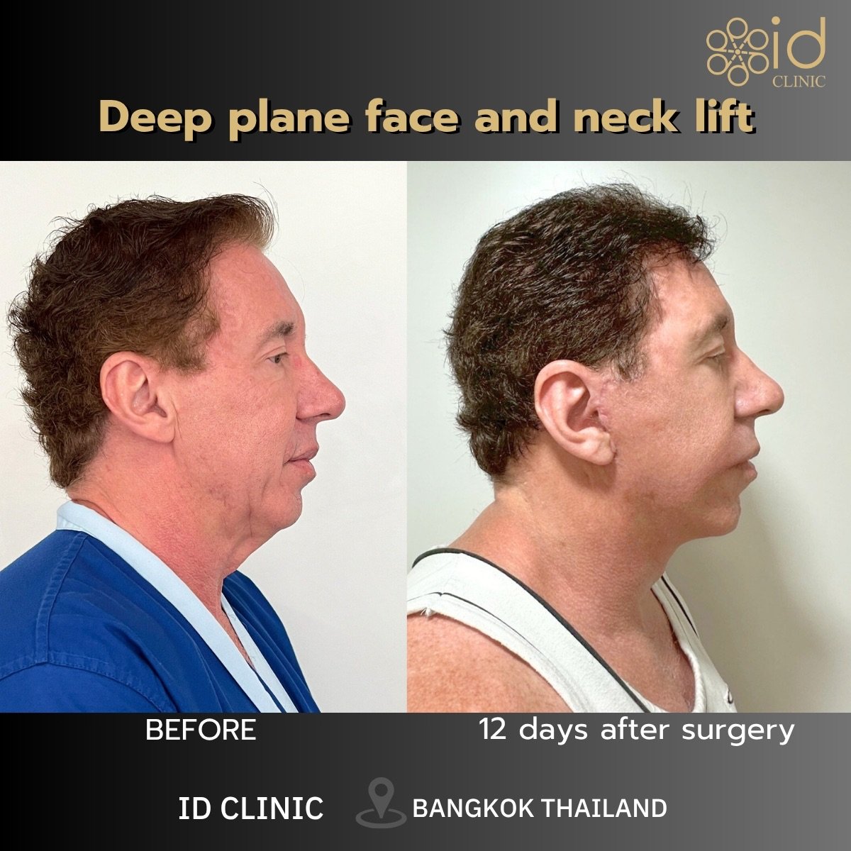 Résultats avant/après lifting profond visage et cou ID Clinic Bangkok, contour visible