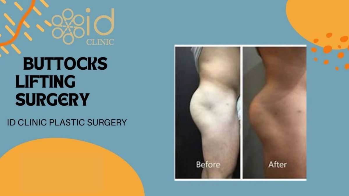 Résultats avant et après lifting des fesses à ID Clinic Bangkok, contour amélioré