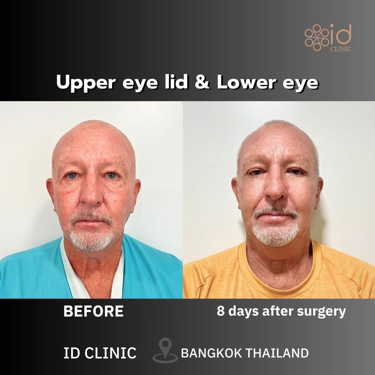 Résultats avant/après blépharoplastie supérieure et inférieure à ID Clinic Bangkok, 8 jours