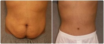 Before and after tummy tuck results at Asia Cosmetic Hospital, improved abdominal contour
