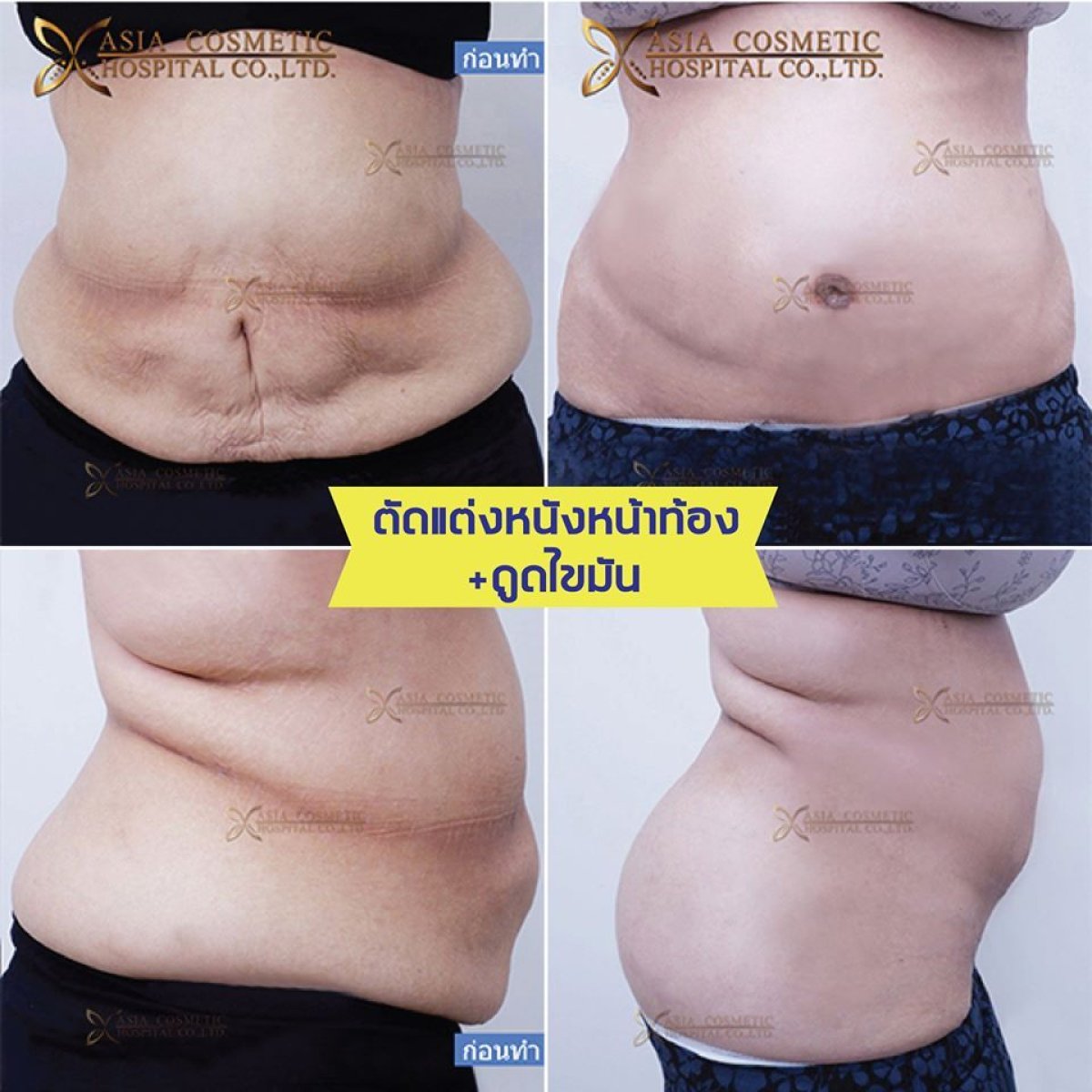 Vorher-nachher-Ergebnis Bauchdeckenstraffung bei Asia Cosmetic Hospital, sichtbare Kontur