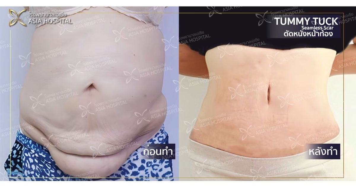 Vorher-nachher-Ergebnis der Bauchdeckenstraffung bei Asia Cosmetic Hospital, sichtbare Konturverbesserung