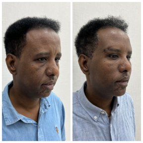 Before and after brow lift results at CE International Hospital, visible forehead lift improvement