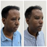 Before and after brow lift results at CE International Hospital, visible forehead lift improvement