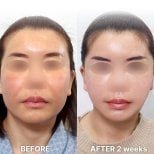 Результаты до и после Deep Plane Facelift в Returning Plastic Surgery, 2 недели после