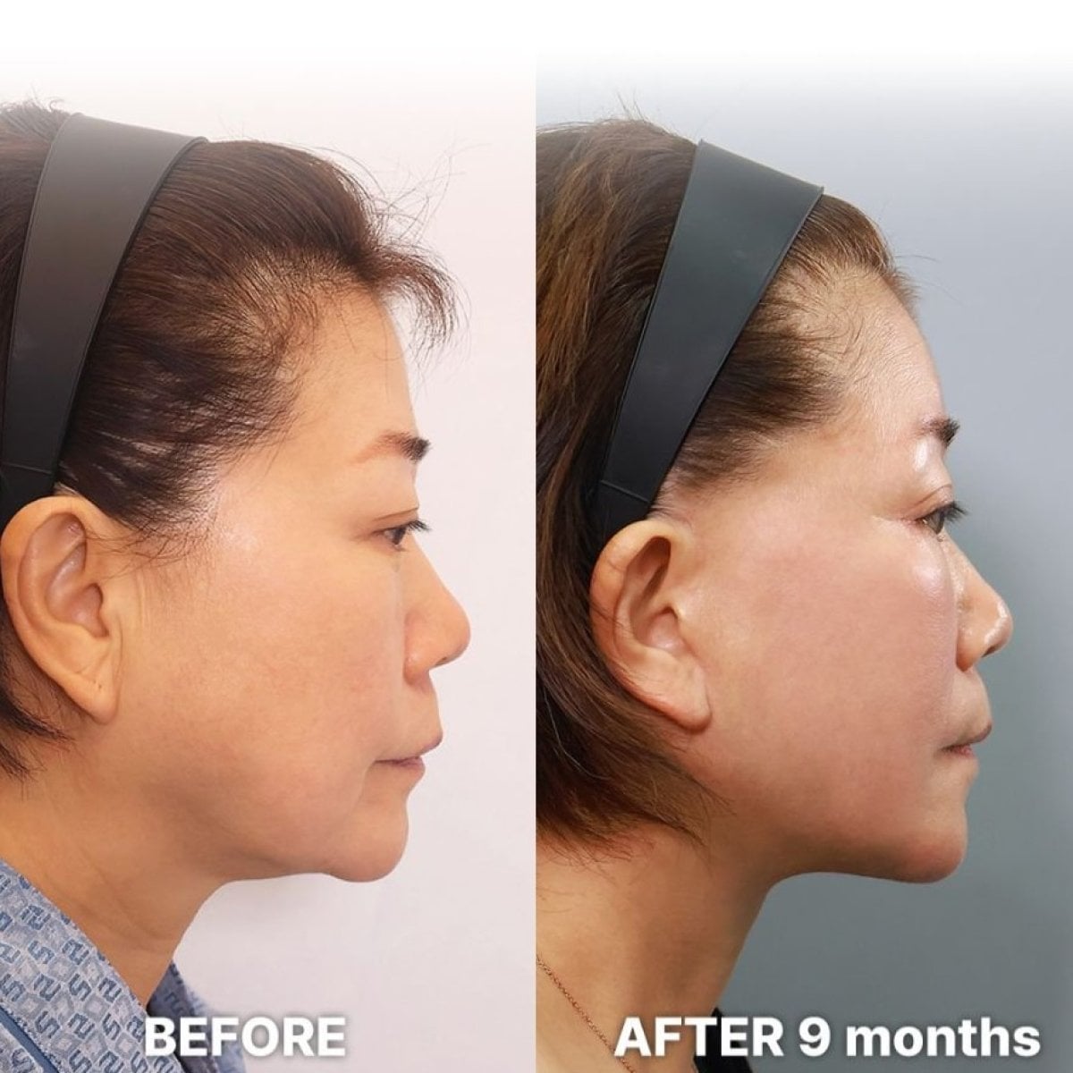 نتائج شد الوجه العميق قبل وبعد في Returning Plastic Surgery بعد 9 أشهر