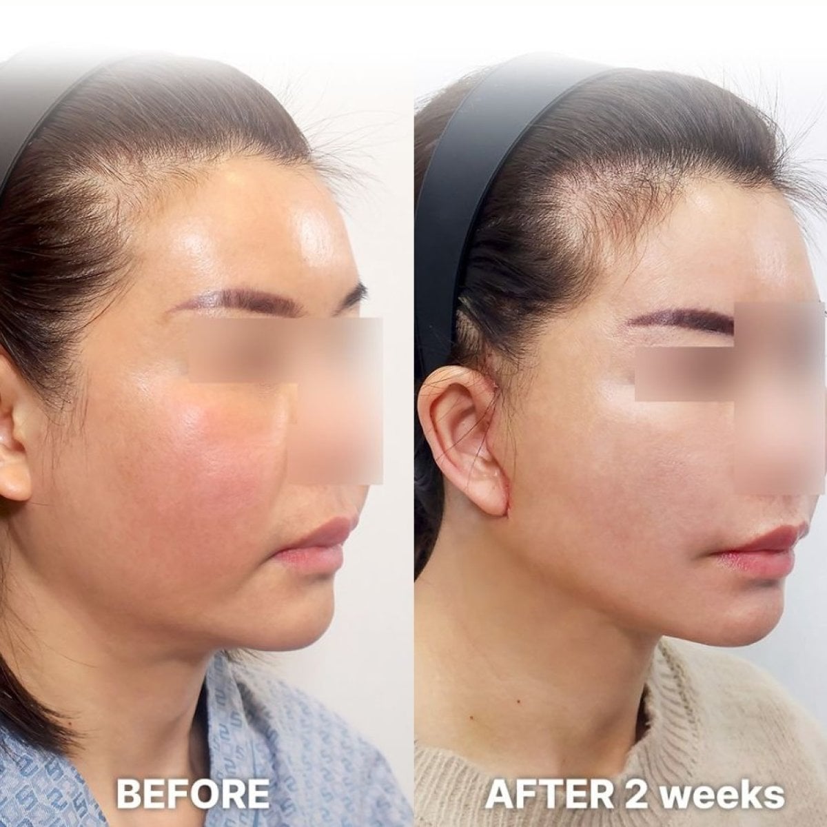 Resultados antes y después de Deep Plane Facelift en Returning Plastic Surgery, 2 semanas