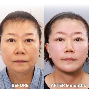 Результаты до и после deep plane facelift в Returning Plastic Surgery, 9 месяцев спустя