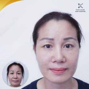 Facelift before and after results at Asia Cosmetic Hospital, visible facial rejuvenation