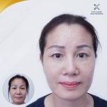 Facelift before and after results at Asia Cosmetic Hospital, visible facial rejuvenation