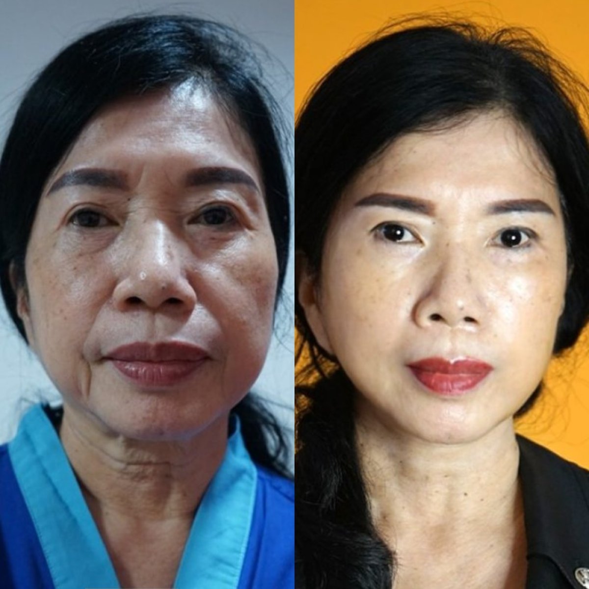 Resultados de lifting facial antes y después en Asia Cosmetic Hospital, rejuvenecimiento visible