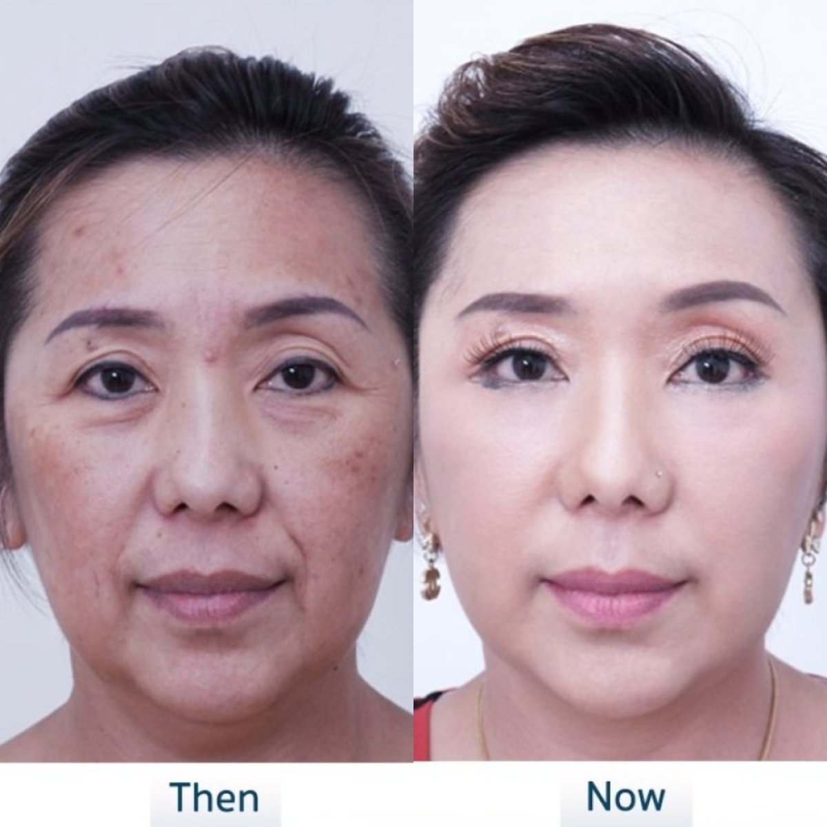 Resultados de lifting facial antes y después en Asia Cosmetic Hospital, rejuvenecimiento visible