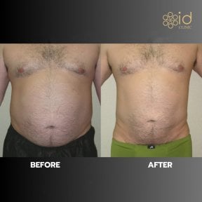 Before and after liposuction results at ID Clinic Bangkok, visible abdominal fat reduction