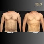 Before and after liposuction results at ID Clinic Bangkok showing improved male body contour