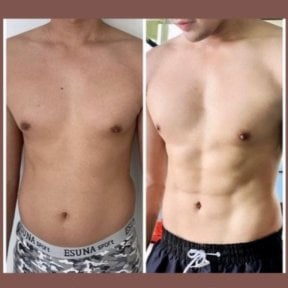Before and after liposuction results at ID Clinic Bangkok, visible male abdominal contouring