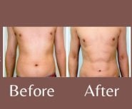 Before and after liposuction results at ID Clinic Bangkok, visible abdominal contour improvement