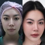 نتائج عملية تجميل الأنف قبل وبعد، إعادة تشكيل الأنف لتحسين تناسق الوجه