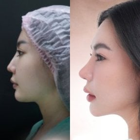 نتائج عملية تجميل الأنف قبل وبعد، تحسين طبيعي لشكل الأنف الجانبي