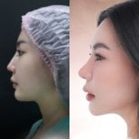 نتائج عملية تجميل الأنف قبل وبعد، تحسين طبيعي لشكل الأنف الجانبي