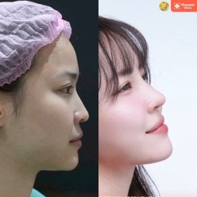 نتائج عملية تجميل الأنف قبل وبعد في عيادة Vincent، إعادة تشكيل الأنف بمظهر طبيعي