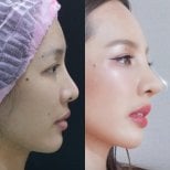 نتائج عملية تجميل الأنف قبل وبعد، إعادة تشكيل الأنف وتحسين المظهر الجانبي