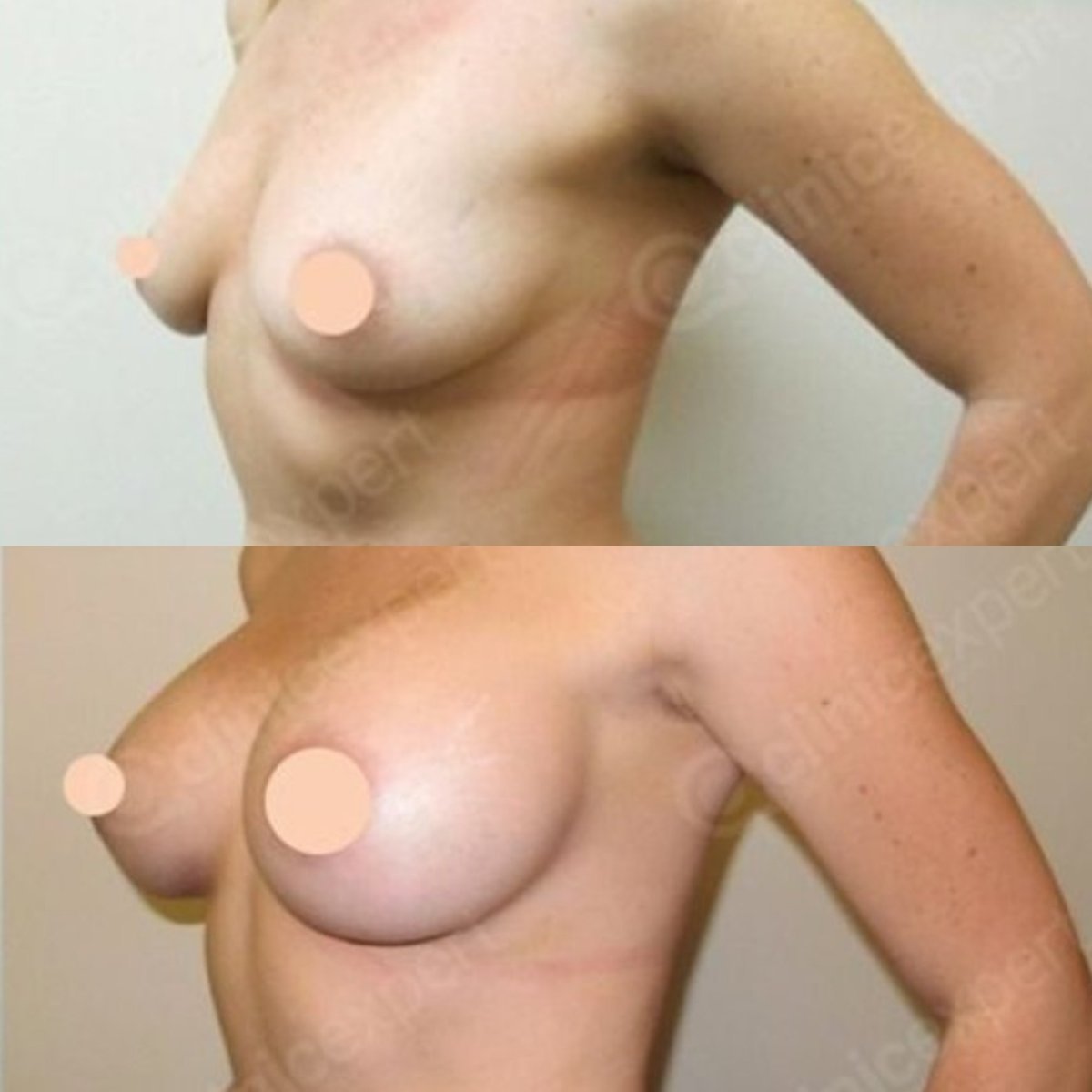 До и после подтяжки груди с круглыми имплантами в CE International Hospital, видимый результат