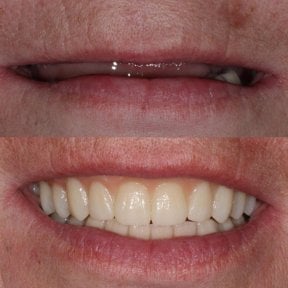 Vorher-nachher-Ergebnis Zahnimplantat bei Smile Centrum – wiederhergestelltes Lächeln