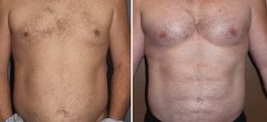 Before and after pectoral implants at Wansiri Hospital, enhanced chest contour results