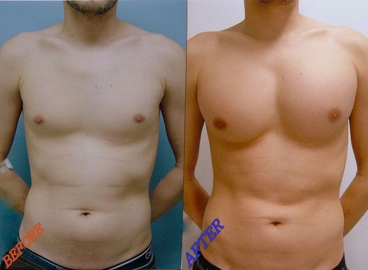 Antes y después de implantes pectorales en Wansiri Hospital: mejora del contorno torácico