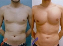 Before and after pectoral implants at Wansiri Hospital – enhanced male chest contour result