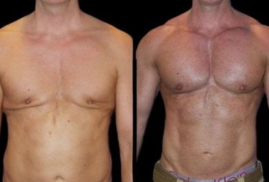 Before and after pectoral implants at Wansiri Hospital, enhanced chest contour results