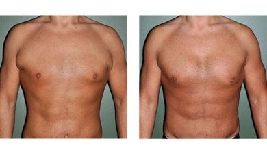 Before and after pectoral implants at Wansiri Hospital, enhanced chest contour results