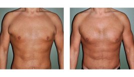 Before and after pectoral implants at Wansiri Hospital, enhanced chest contour results