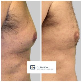Efekty operacji ginekomastii przed i po w Clinica Granado Tiagonce, poprawa konturu klatki