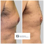 Efekty operacji ginekomastii przed i po w Clinica Granado Tiagonce, poprawa konturu klatki