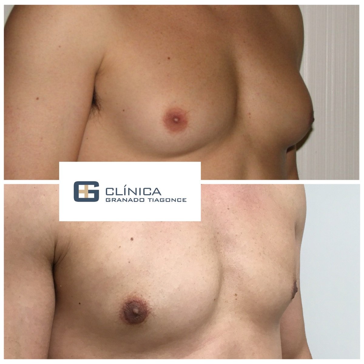 Before and after gynecomastia surgery results at Clinica Granado Tiagonce, male chest contour