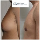 نتائج قبل وبعد جراحة التثدي في Clinica Granado Tiagonce، تحديد صدر الرجل