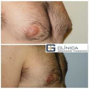 نتائج قبل وبعد جراحة التثدي في Clinica Granado Tiagonce، تحسين شكل صدر الرجل