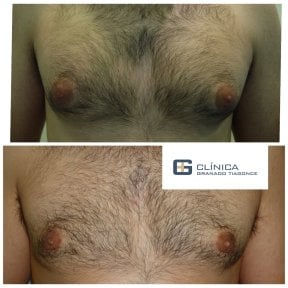 نتائج قبل وبعد جراحة التثدي في Clinica Granado Tiagonce، تحسين شكل صدر الرجل