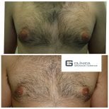 نتائج قبل وبعد جراحة التثدي في Clinica Granado Tiagonce، تحسين شكل صدر الرجل