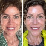 Before and after brow lift results at Dr. Safa Manav Clinic, visible forehead rejuvenation