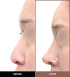 نتائج تجميل الأنف قبل وبعد في URBAN Plastic Surgery، تحسين شكل الأنف الجانبي