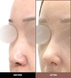 نتائج تجميل الأنف قبل وبعد في URBAN Plastic Surgery، تحسين شكل الأنف