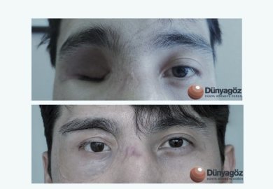 Vorher-nachher-Ergebnisse der Augenprothese in Dunyagoz Eye Hospital Istanbul Altunizade