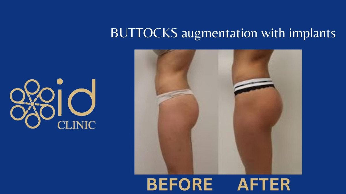 До и после увеличения ягодиц имплантами в ID Clinic Bangkok, видимый результат объема
